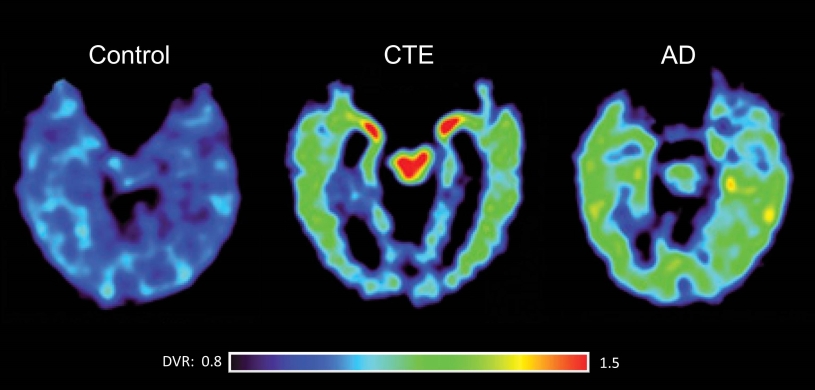 Brain scans of CTE and AD